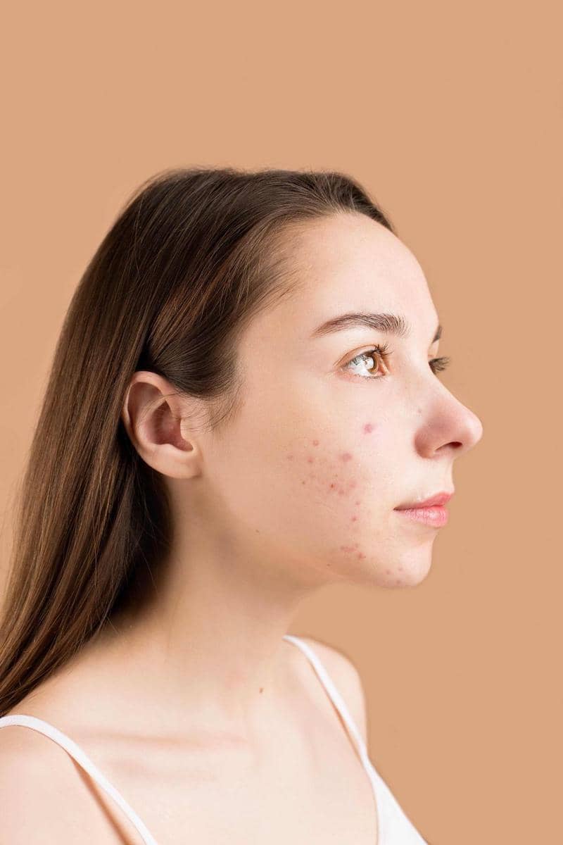ilustrasi skin barrier yang rusak (pexels.com/Anna Nekrashevich)