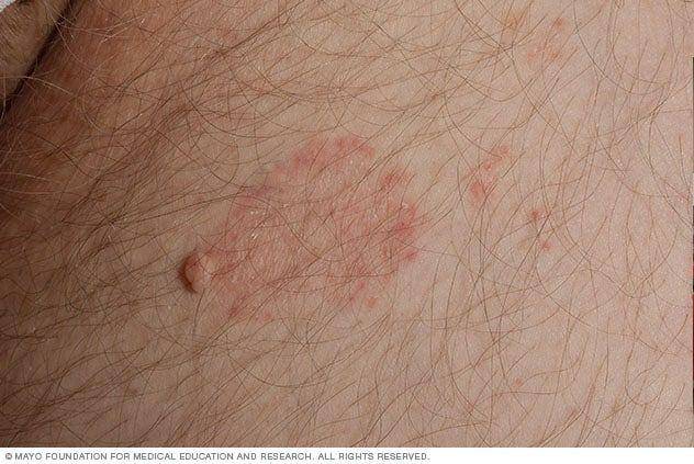 ilustrasi tinea cruris (mayoclinic.org)