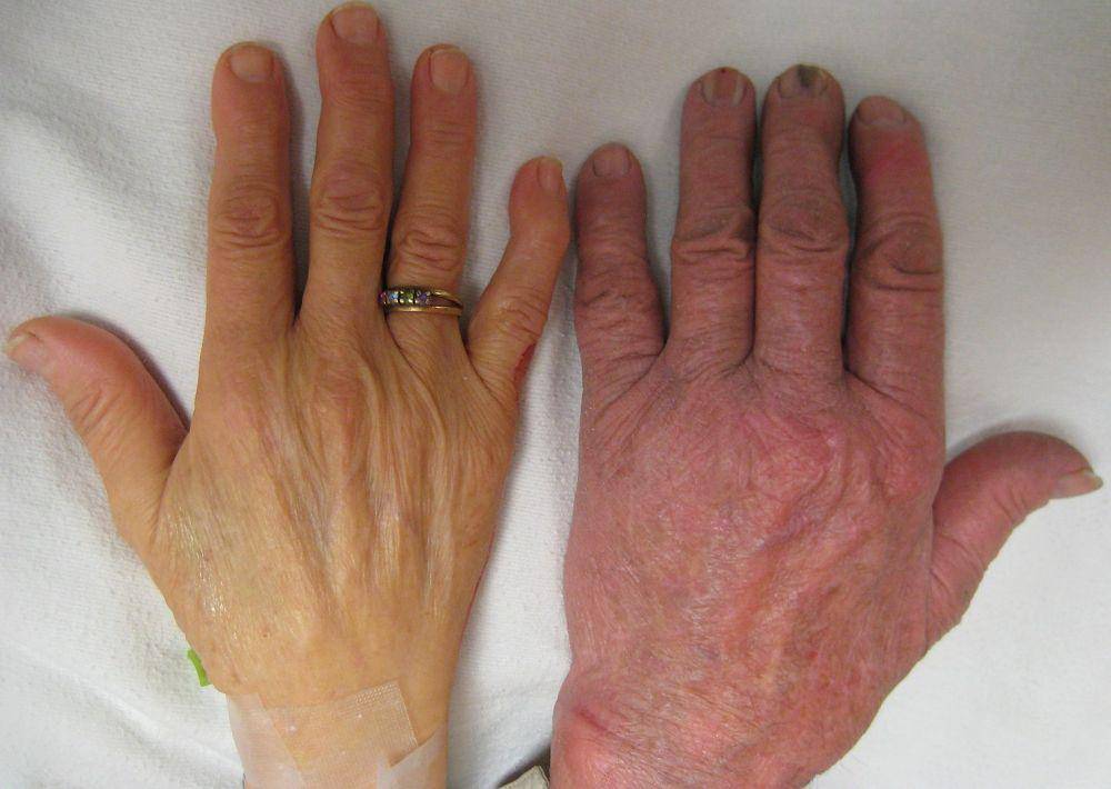 ilustrasi perbandingan tangan penderita anemia (memakai cincin) dengan orang normal (wikipedia.org)