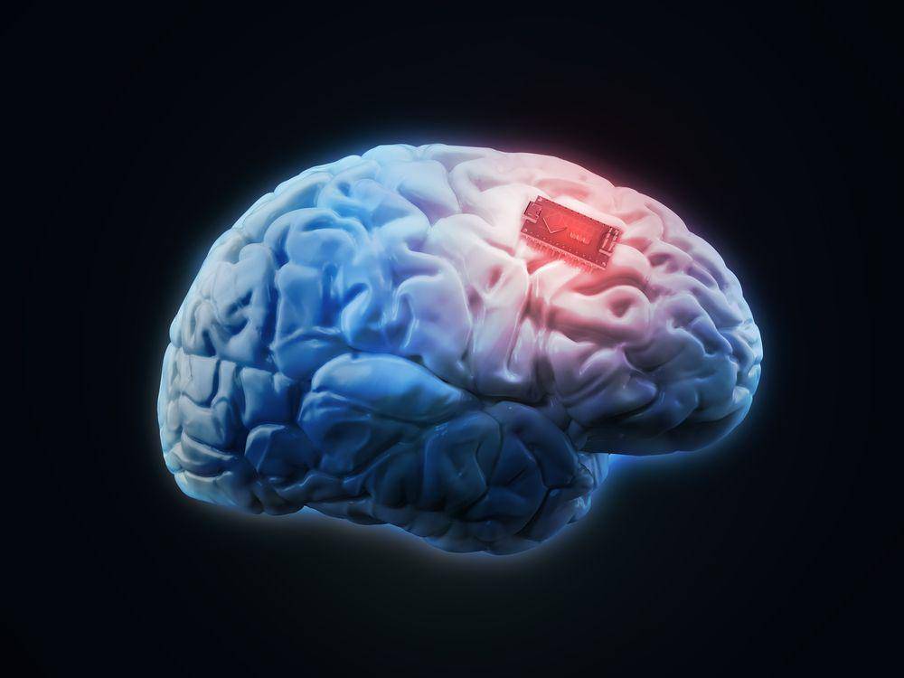 ilustrasi implan memori di otak (shutterstock via alzheimersnewstoday.com)