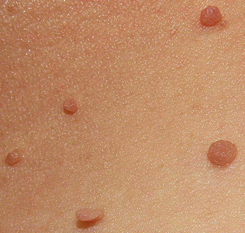 ilustrasi skin tag, salah satu bentuk pertumbuhan kulit yang jinak (commons.wikimedia.org/Jmarchn)
