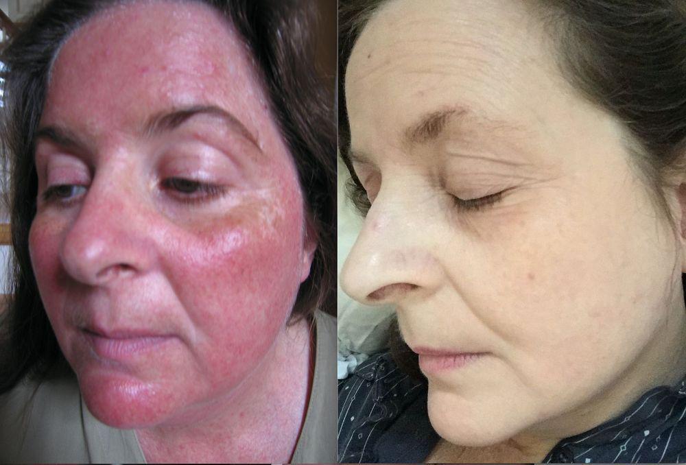 5 Jenis Makanan yang Harus Dihindari Pengidap Rosacea