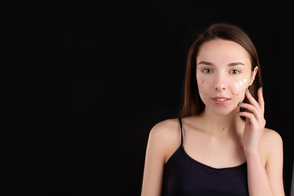 5 Kandungan Skincare untuk Menghilangkan Bekas Jerawat, Ampuh!