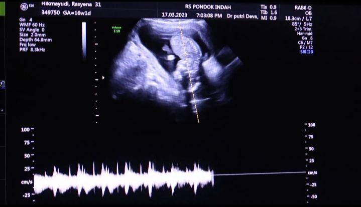 potret Bima Aryo dan istri umumkan hamil anak pertama (instagram.com/rasyenahikmayudi)