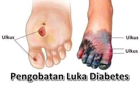 Pengobatan luka diabetes/facebook.com/ika devi