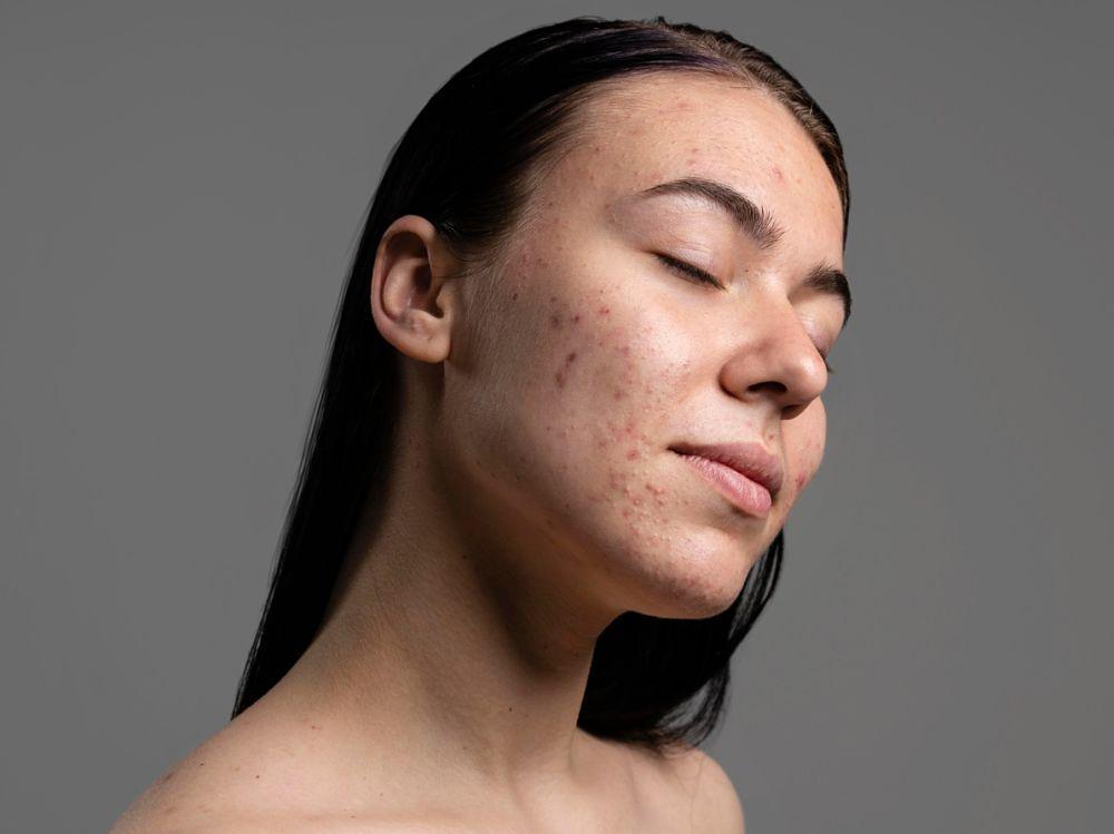 5 Kandungan Skincare yang Ampuh Samarkan Bekas Jerawat