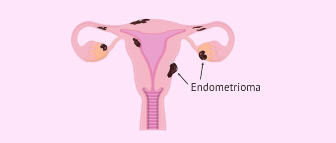 ilustrasi kista endometriosis, endometrioma (invitra.com)