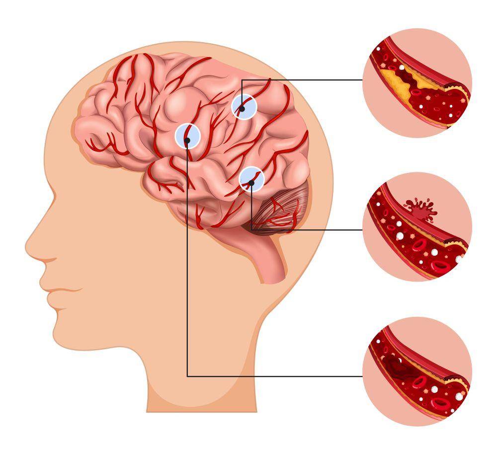ilustrasi stroke (freepik.com/brgfx)