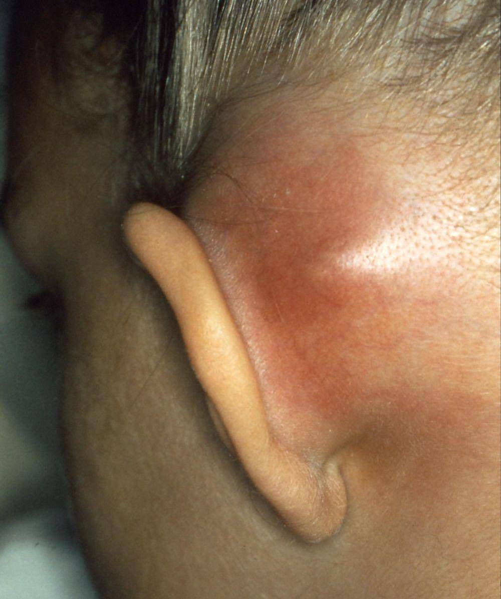 Ilustrasi mastoiditis (Wikipedia.org)