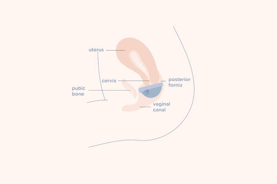 ilustrasi penggunaan menstrual disc (dok. Saalt)