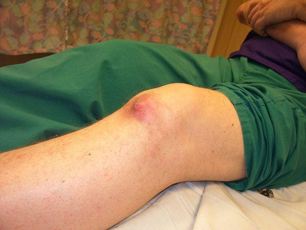 Gejala Penyakit Asam Urat dan Faktor Risikonya, Waspadai! | IDN Times