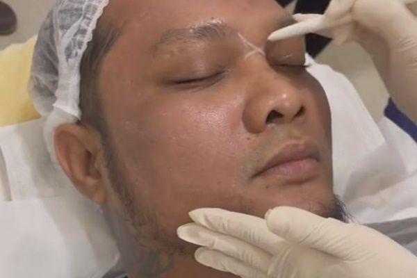 8 Potret Virgoun Tanam Benang Hidung, Demi Bentuk Proporsional