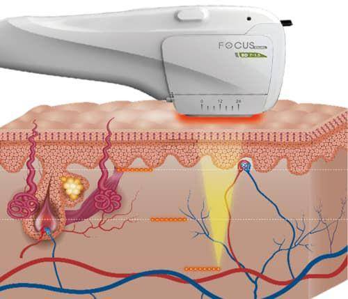ilustrasi HIFU treatment (bristolaesthetics.org.uk)
