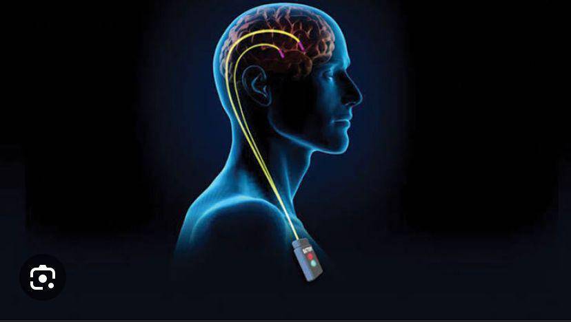 ilustrasi deep brain stimulation (Dok. RS Siloam)