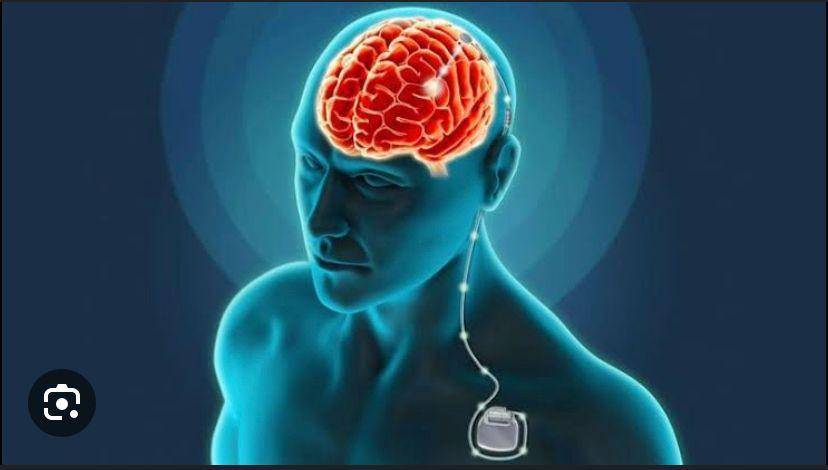 ilustrasi deep brain stimulation (Dok. RS Siloam)