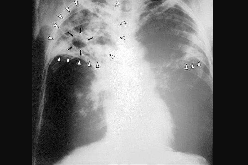 Ilustrasi Pasien TBC. (Wikimedia.org/CDC)