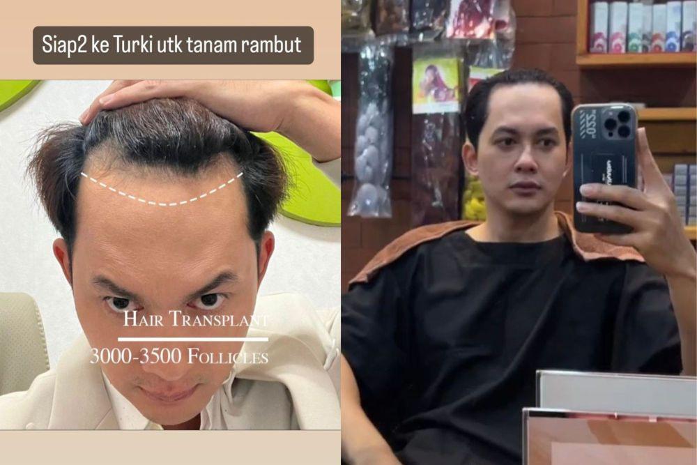 7 Potret Kiki Farrel Pamer Jidat, Siap-siap Mau Tanam Rambut di Turki