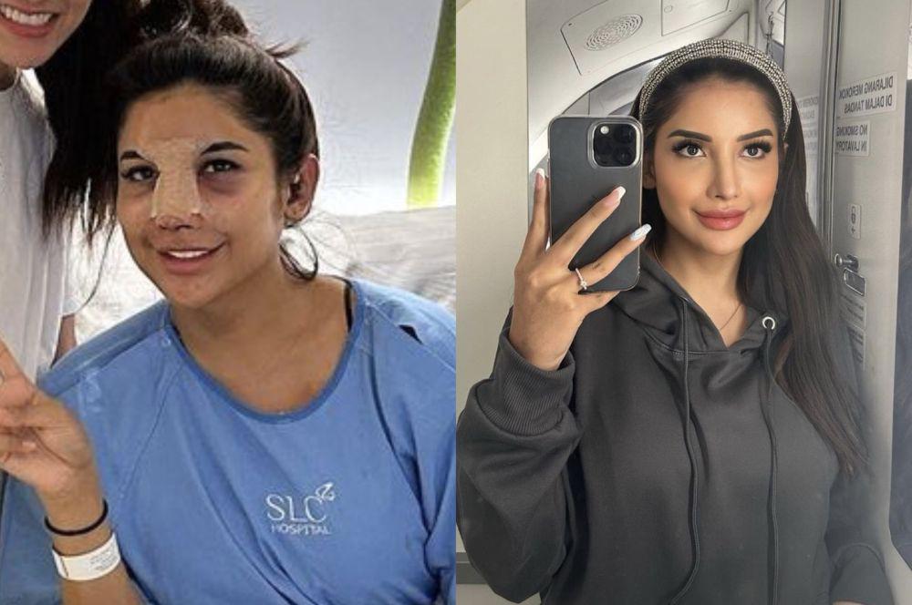7 Potret Millen Cyrus Usai Operasi Plastik di Hidung, Mirip Ashanty?
