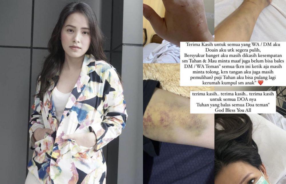 Sempat Dikira Settingan, Lady Nayoan Perlihatkan Luka Imbas Kecelakaan