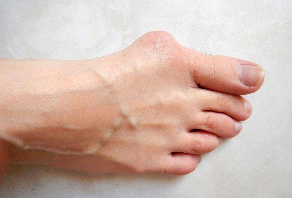 ilustrasi bunion (commons.wikimedia.org/Lamiot)