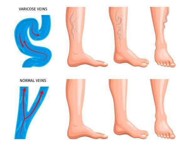 3 Perbedaan Spider Veins dan Varises, Jangan Tertukar ya!