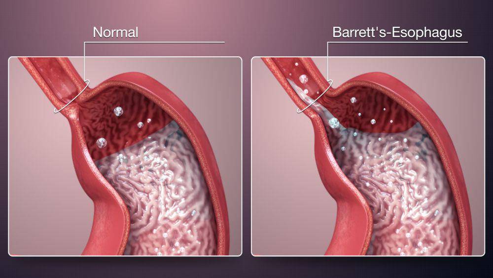 ilustrasi esofagitis Barrett (scientificanimations.com)