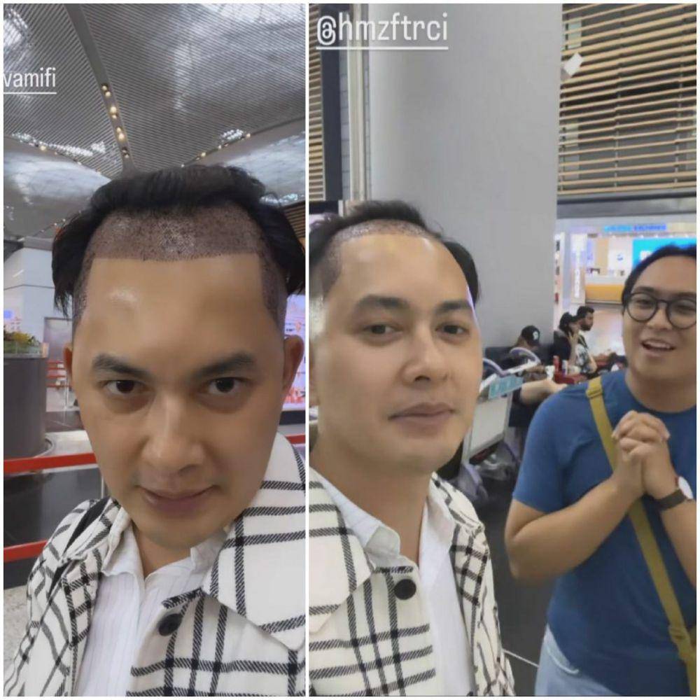potret Kiki Farrel jalani operasi transplantasi rambut di Turki (instagram.com/kikifarrel_)