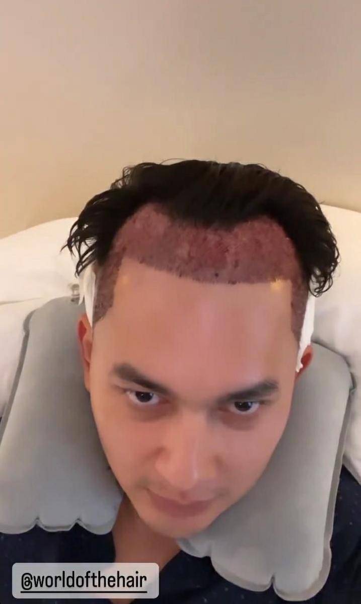 potret Kiki Farrel jalani operasi transplantasi rambut di Turki (instagram.com/kikifarrel_)