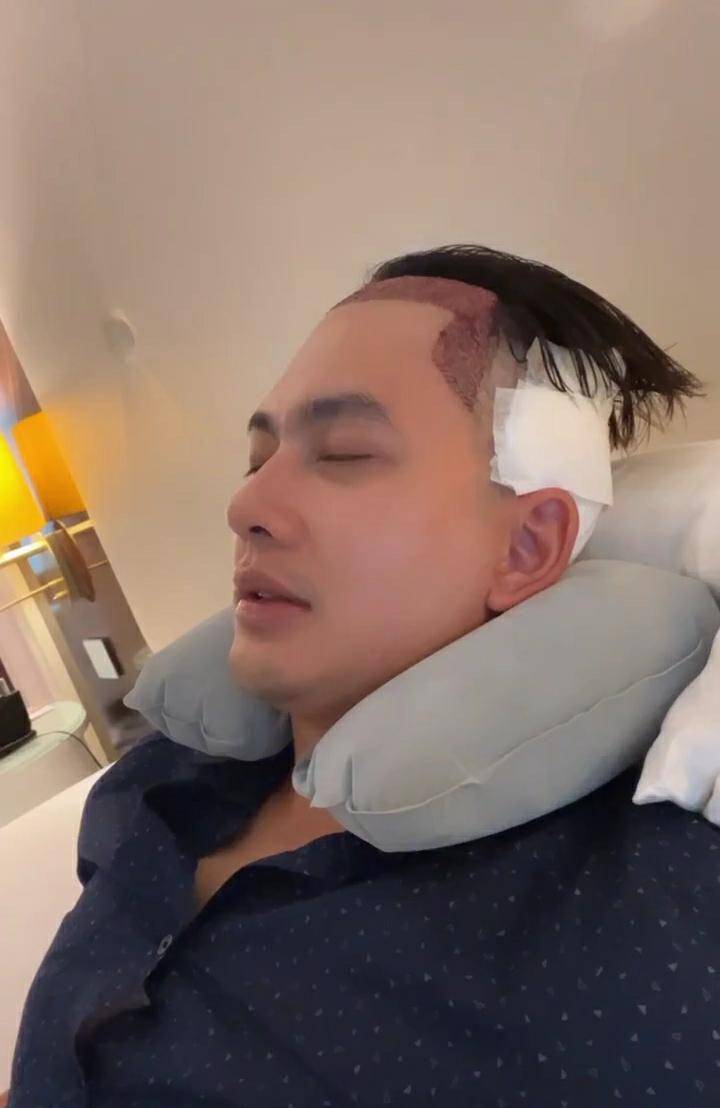 potret Kiki Farrel jalani operasi transplantasi rambut di Turki (instagram.com/kikifarrel_)
