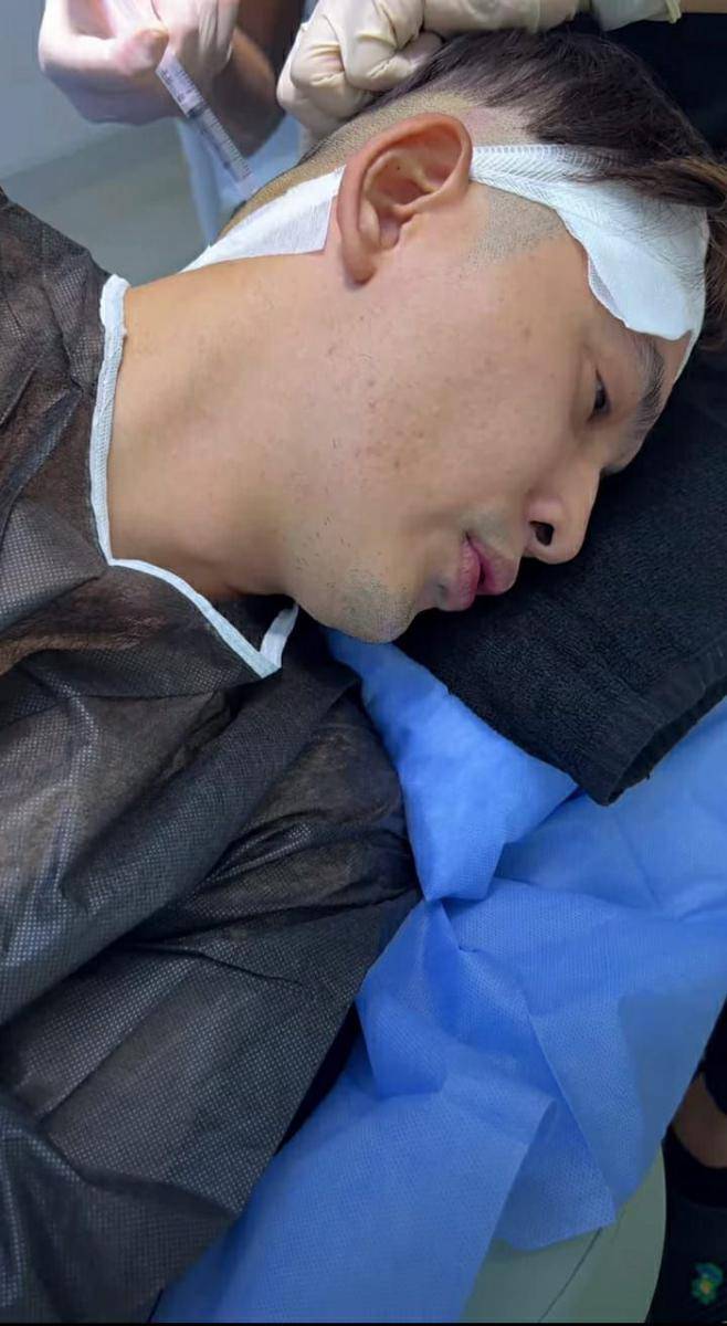 potret Kiki Farrel jalani operasi transplantasi rambut di Turki (instagram.com/kikifarrel_)
