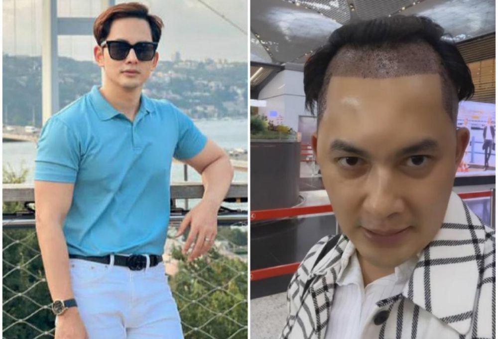 10 Potret Kiki Farrel Jalani Operasi Transplantasi Rambut