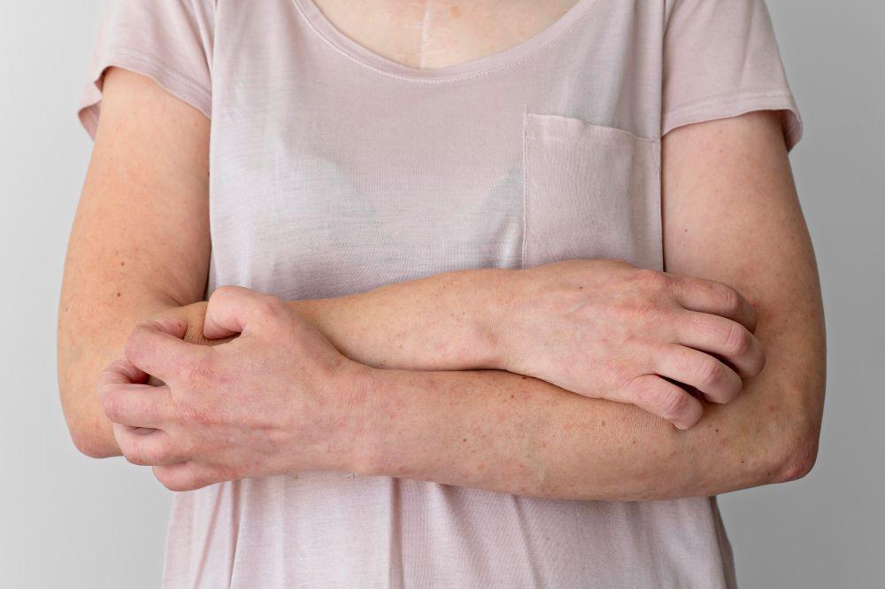10 Cara Menghilangkan Kurap Secara Medis dan Alami, Ampuh!