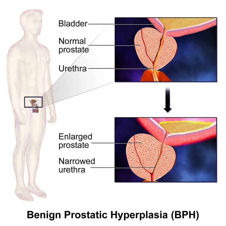 ilustrasi benign prostatc hyperplasia (BPH) atau hiperplasia prostat jinak (commons.wikimedia.org/BruceBlaus)