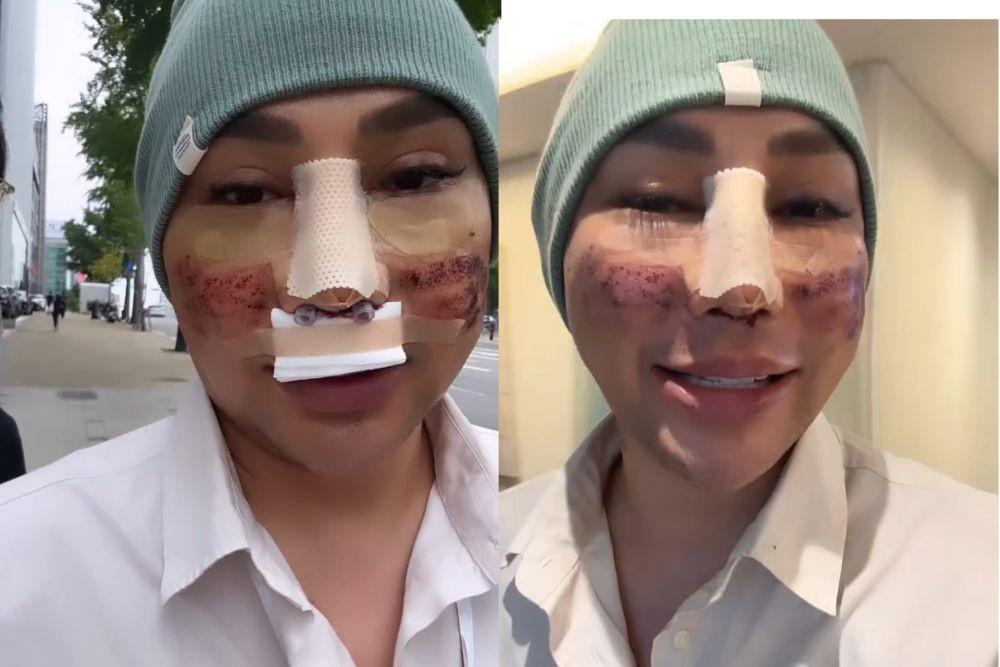 7 Potret Kondisi Caren Delano Usai Oplas Hidung di Korea