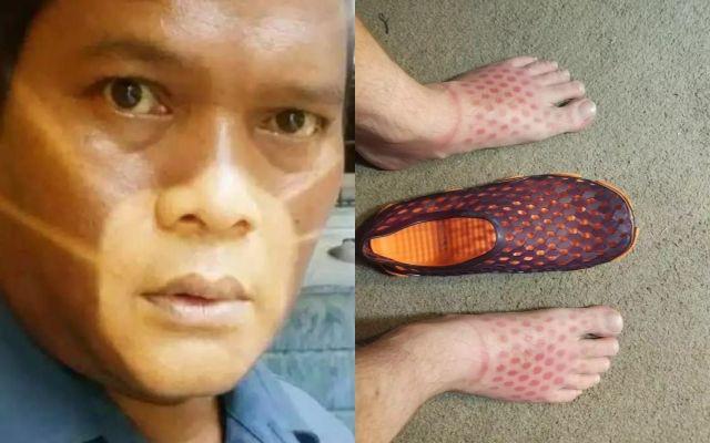 10 Potret Kocak Orang Kulitnya Belang, Senang Panas-panasan?