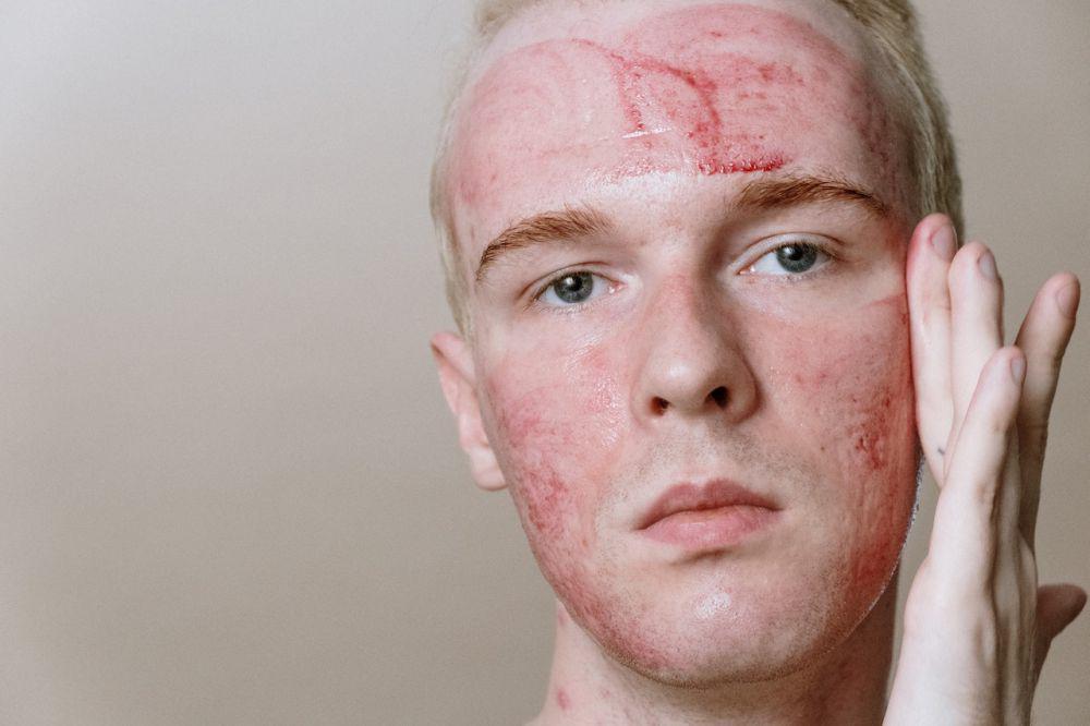 Sunburn Vs. Sun Poisoning, Apa Bedanya?