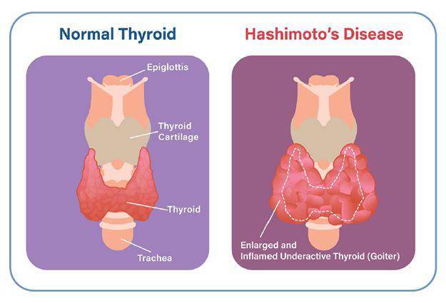 ilustrasi penyakit Hashimoto (thyroid.org)