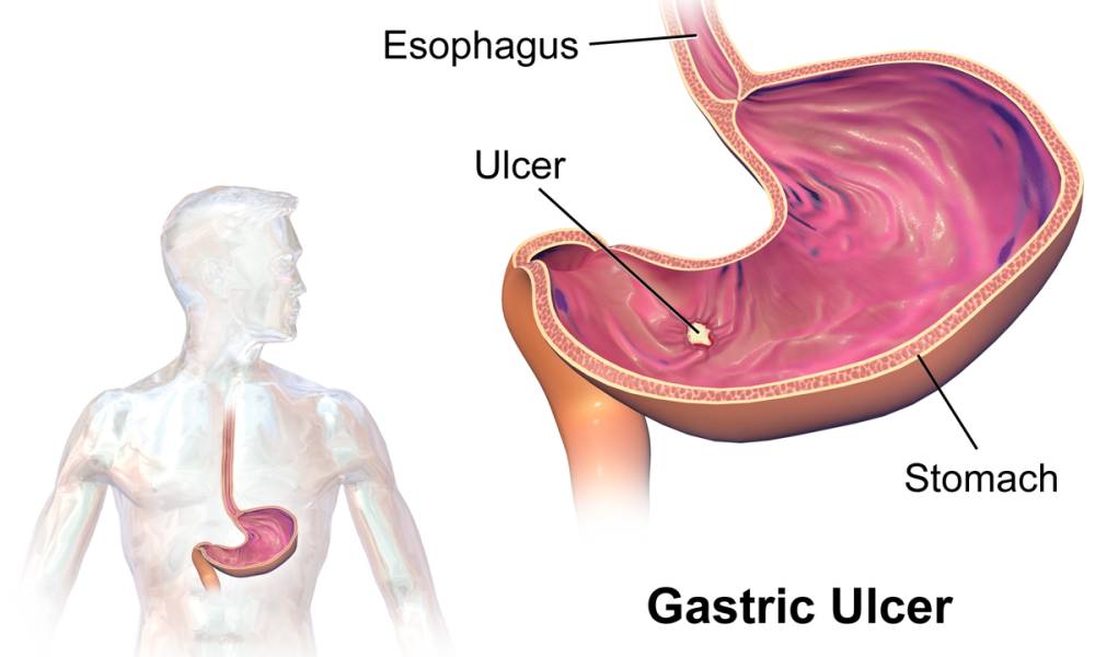ilustrasi tukak lambung, peptic ulcer, atau gastric ulcer (commons.wikimedia.org/BruceBlaus)