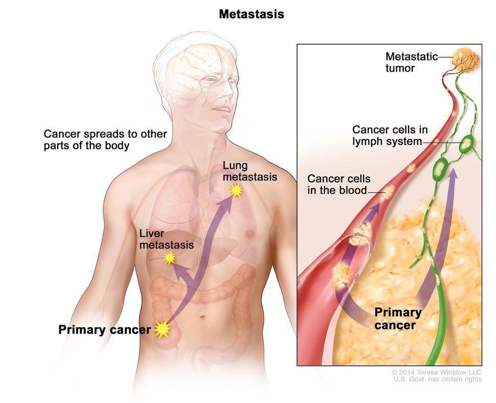 ilustrasi metastasis kanker (cancer.gov/Terese Winslow)