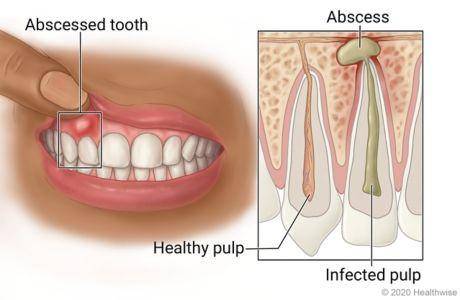 ilustrasi abses gigi (nyp.org/Healthwise)