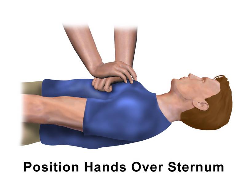 ilustrasi memberi cpr (commons.wikimedia/bruceblaus)