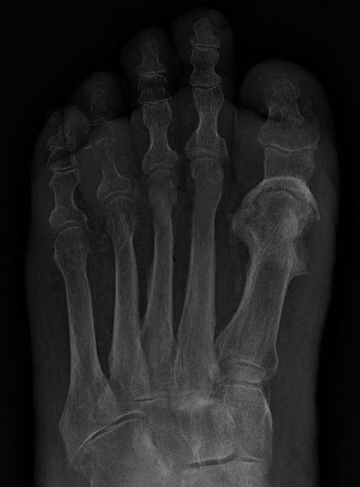Osteomielitis pada ibu jari kaki terlihat pada hasil rontgen. (commons.wikimedia.org/James Heilman, MD)