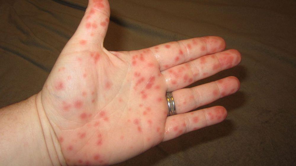 Gejala Flu Singapura, Penyakit Tangan, Kaki, dan Mulut akibat Virus