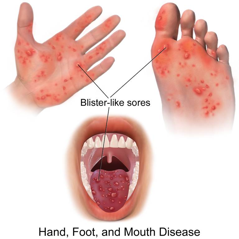 Gejala flu Singapura atau hand, foot and mouth disease (HFMD). (commons.wikimedia.org/BruceBlaus)