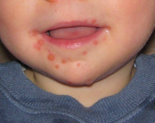 Flu Singapura atau hand, foot, and mouth disease (HFMD). (commons.wikimedia.org/MidgleyDJ)