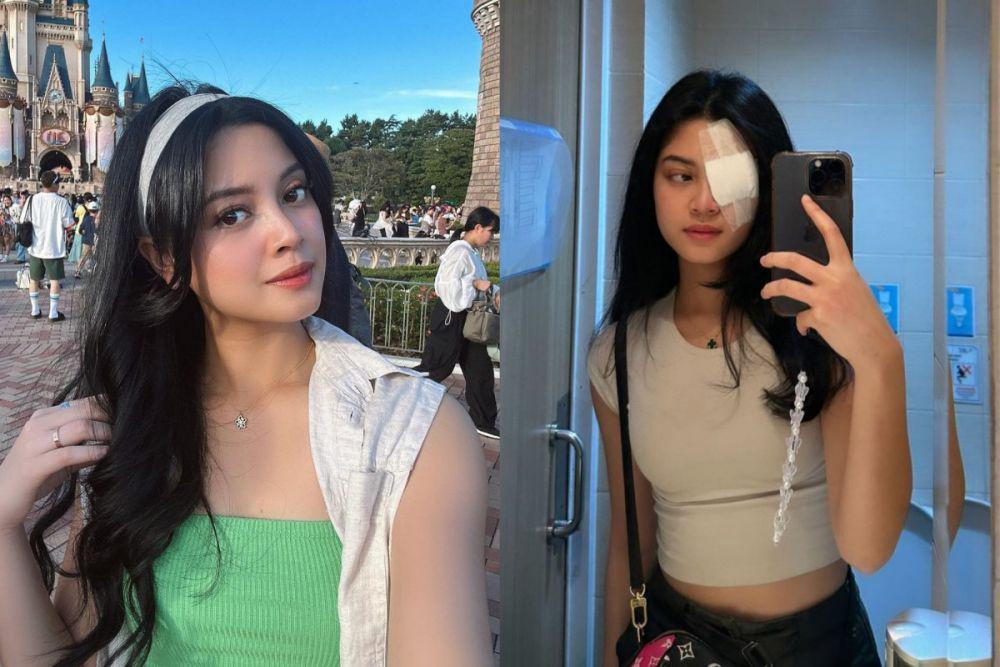 Yoriko Angeline Operasi Mata, Kena Penyakit Hordeolum dan Chalazion