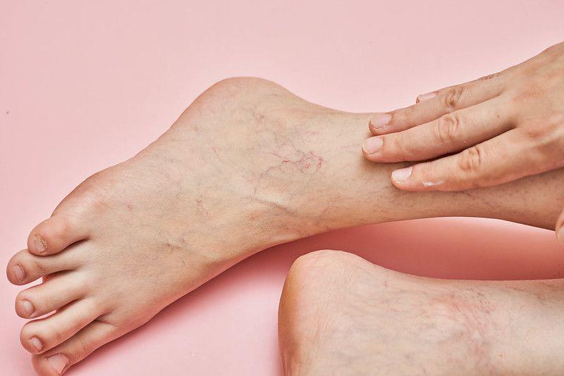 Apa Saja Ciri-ciri Varises Ringan pada Kaki?