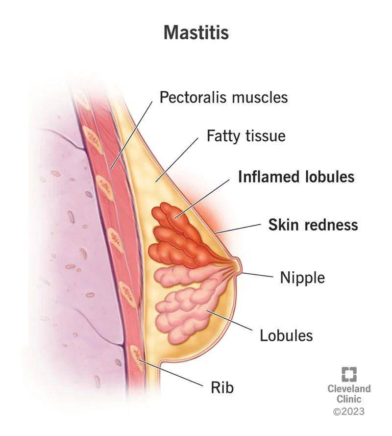 ilustrasi mastitis (clevelandclinic.org)