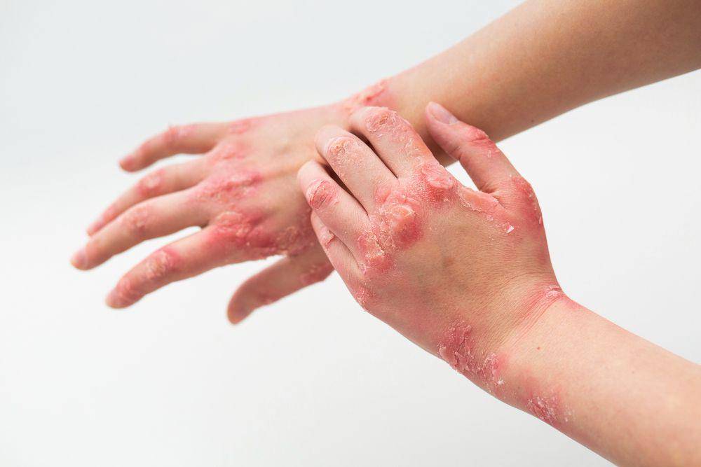 ilustrasi penyakit kulit scabies (freepik.com/freepik)