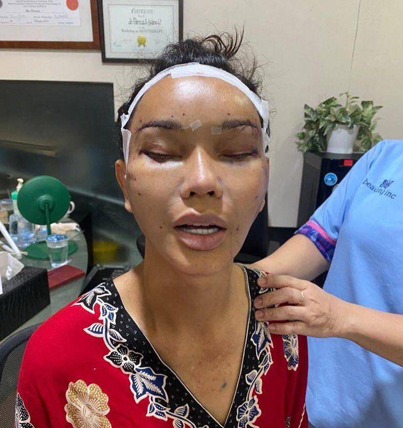 Bunda Corla operasi plastik (Instagram.com/ivan_gunawan)